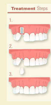 Dental Implant Procedure