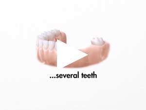 play natural treatment options for missing teeth video