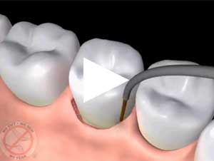 play how LANAP laser gum treatment works video